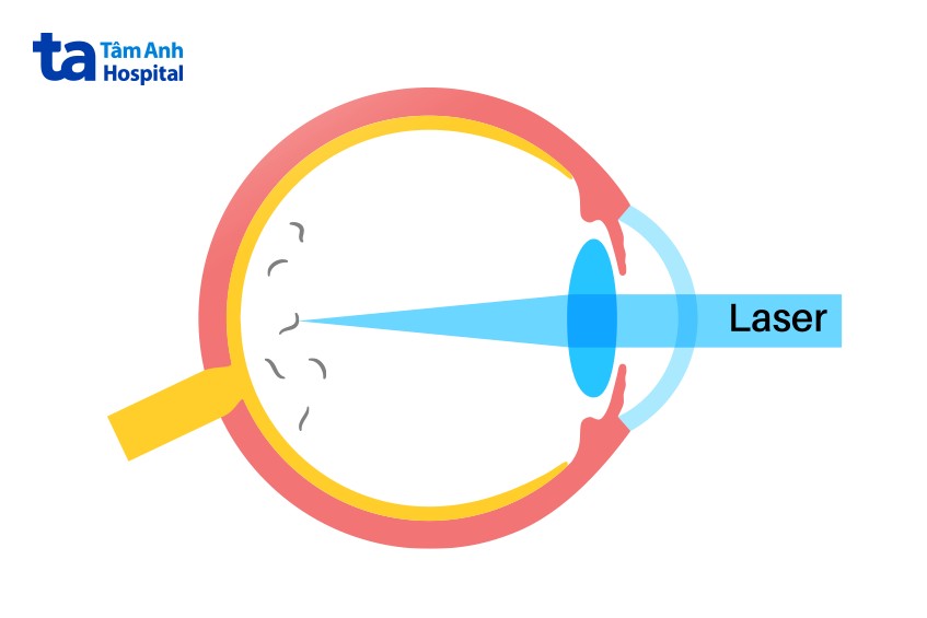 laser cải thiện vẩn đục dịch kính