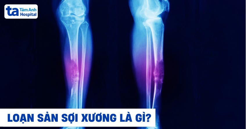 Loạn sản sợi xương là gì? Nguyên nhân, dấu hiệu, cách điều trị