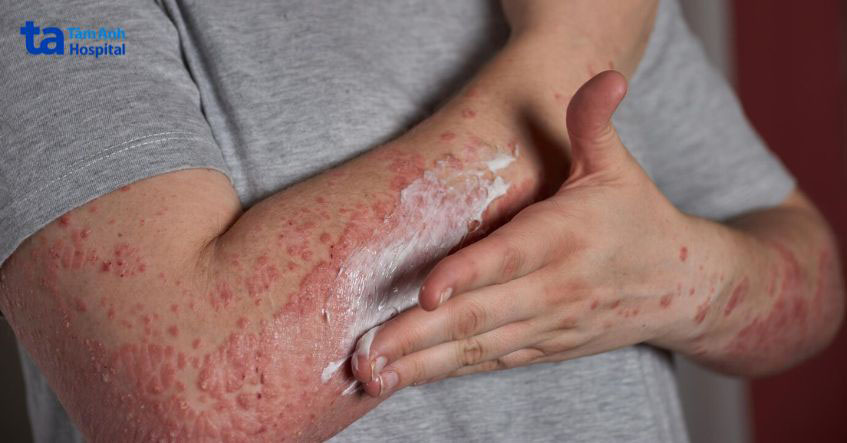Lưu ý điều trị nấm trên da