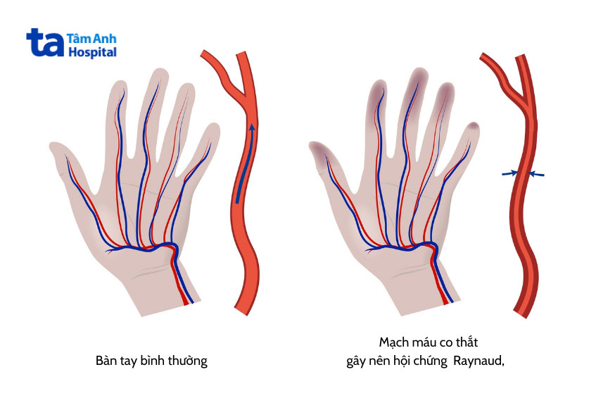 mạch máu co thắt