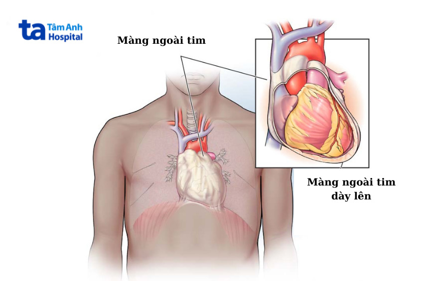Màng ngoài tim cứng và dày lên ở bệnh nhân bị viêm màng ngoài tim co thắt