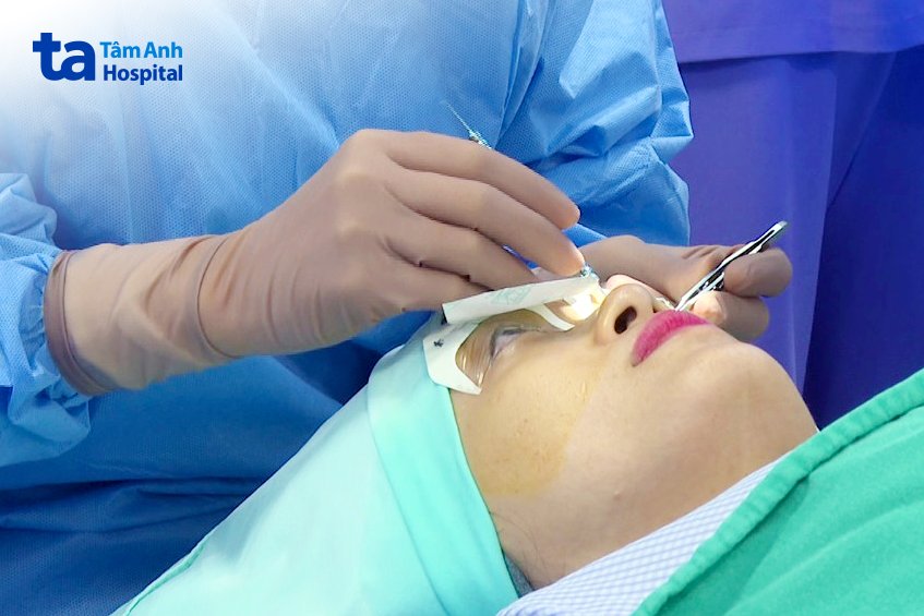 mổ cận bằng nhiều phương pháp hiện đại