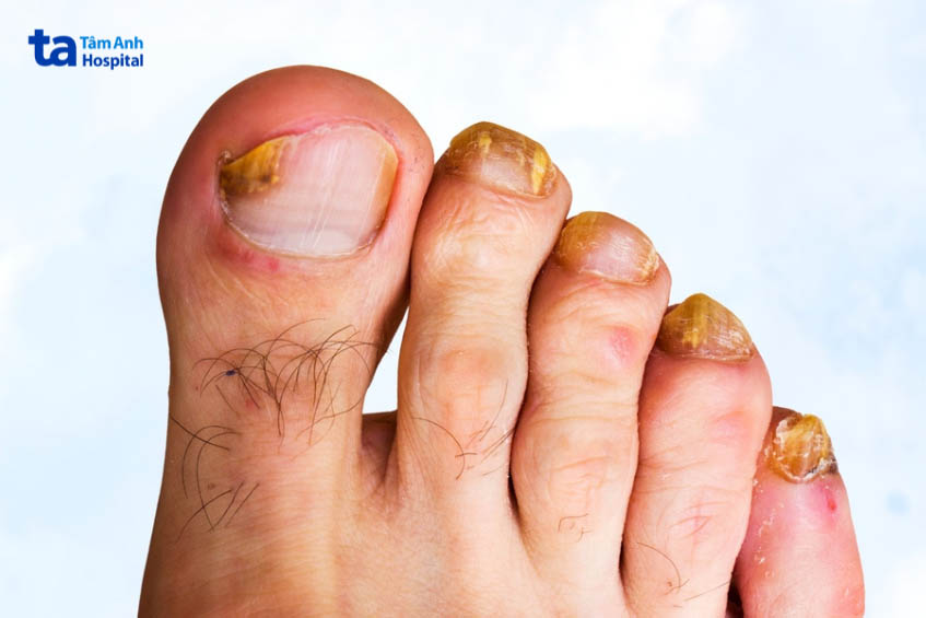 Móng ngón chân bị nấm
