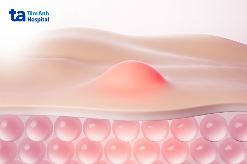 mụn nhọt là khối u nhỏ trên bề mặt da