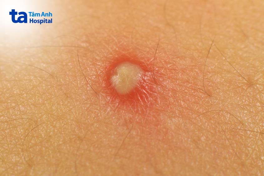 mụn nhọt nhẹ ở bụng có thể tự lành