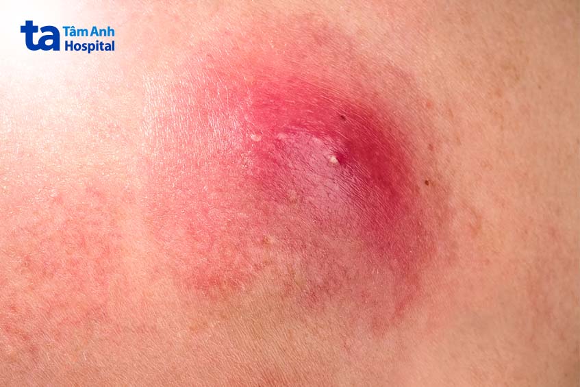 mụn nhọt phát triển thành áp se