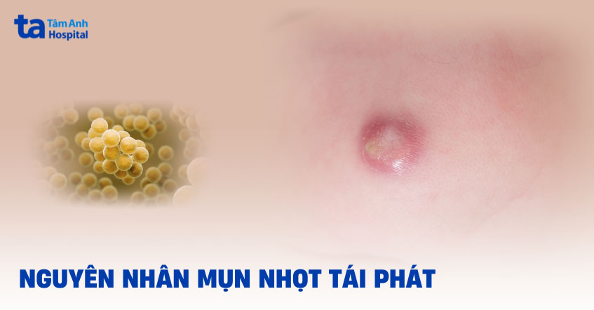 Bị mụn nhọt tái phát nhiều lần do đâu? Cách phòng ngừa hiệu quả