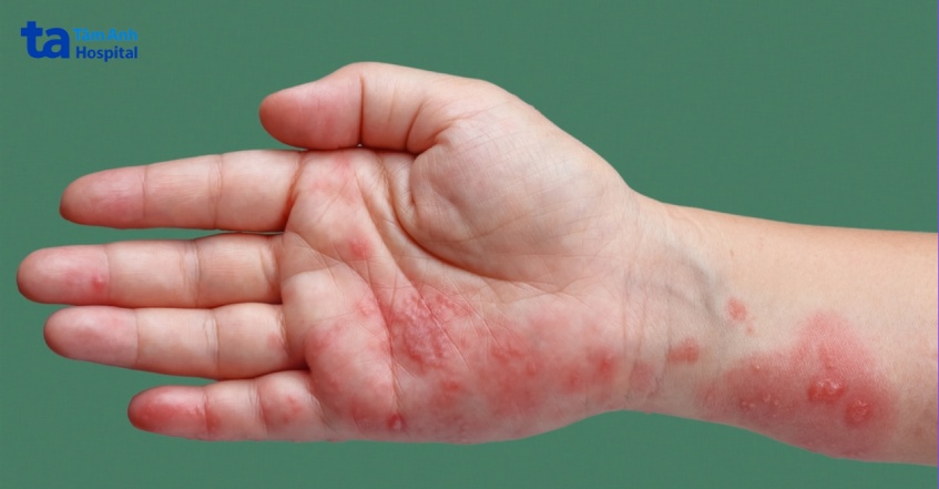 mụn nước do giời leo tập trung thành từng chùm