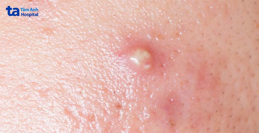 mụt nhọt có khả năng lây sang người khác