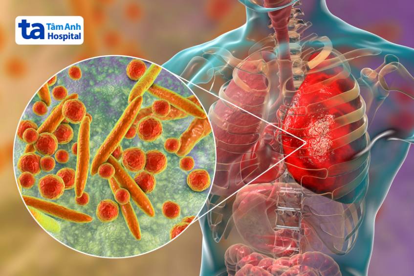 Mycoplasma pneumoniae có thể gây ra bệnh viêm phổi