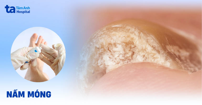 Nấm móng: Hình ảnh, nguyên nhân, dấu hiệu, cách phòng ngừa
