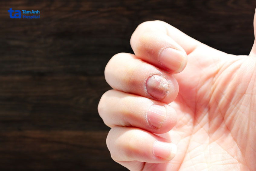 Hình ảnh móng tay bị nấm