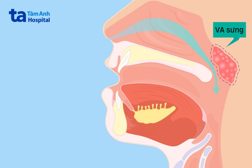 nạo va bằng dao coblator