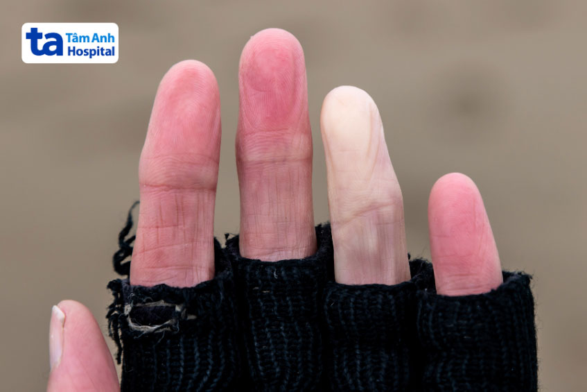 ngón tay bị thay đổi màu da do hội chứng raynaud