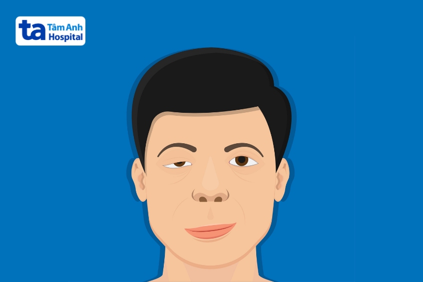 người bệnh nhược cơ sống được bao lâu