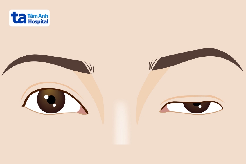 người mắc bệnh nhược cơ có thể bị yếu cơ tại cơ mắt