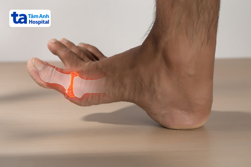 nguyên nhân bị sưng đầu khớp ngón cái