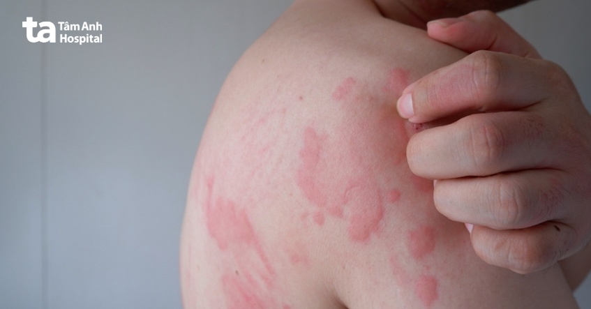 nguyên nhân da nổi đốm nâu và ngứa