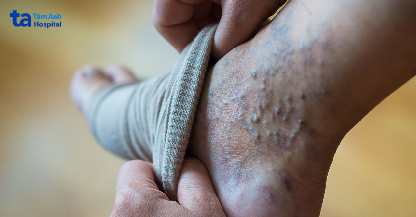 nguyên nhân gây viêm da cơ địa ở chân