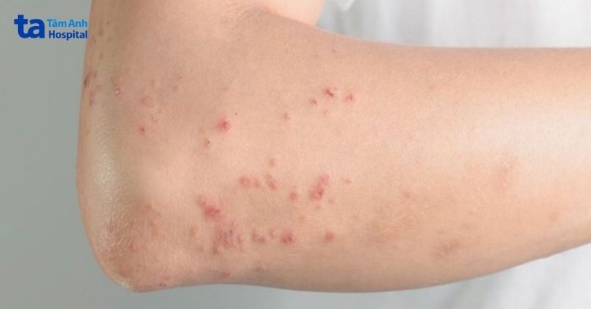 nguyên nhân nổi chấm đỏ trên da