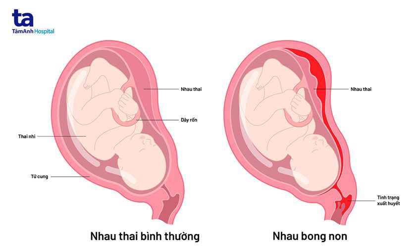 nhau bong non là tai biến sản khoa nguy hiểm
