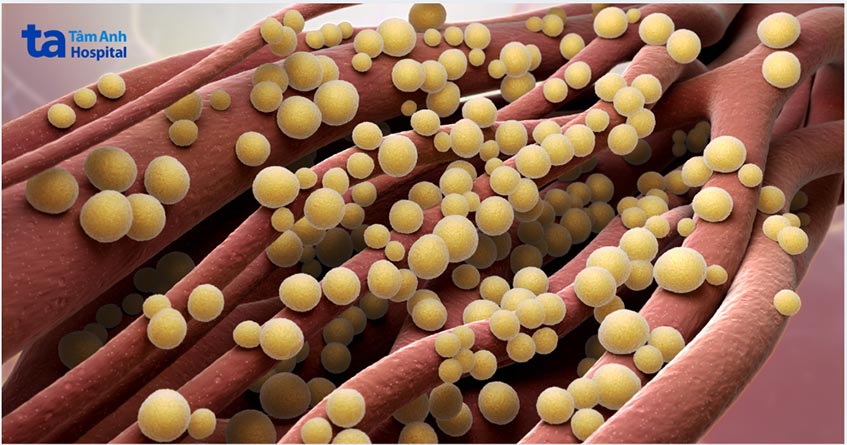 Nhiễm trùng huyết là biến chứng nguy hiểm khi lọc máu liên tục