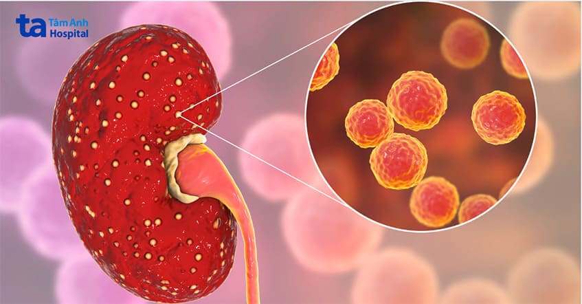 Nhiễm trùng thận gây đau đớn và khó chịu thường do viêm bàng quang gây ra