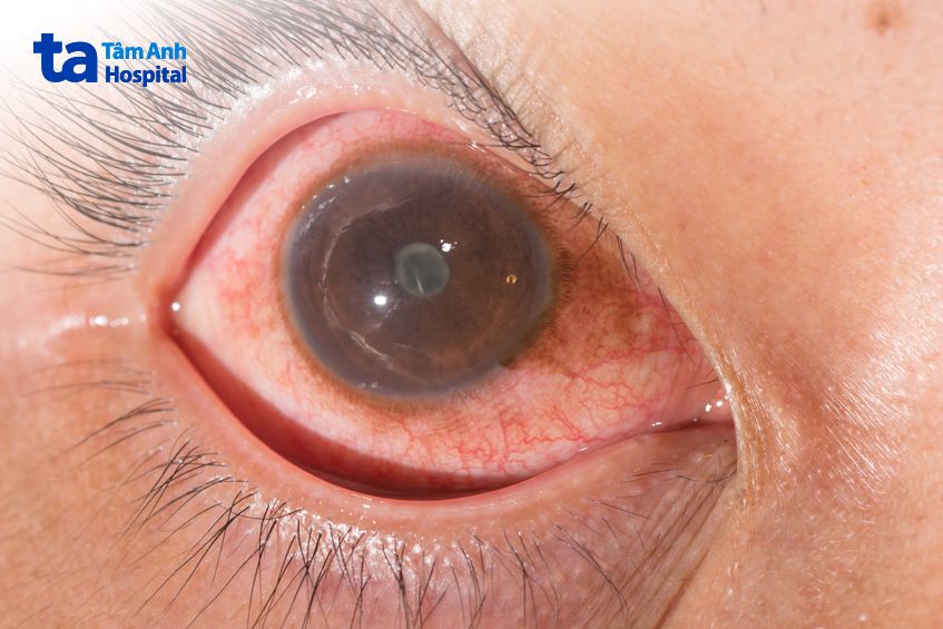 nhiều nguyên nhân dẫn đến viêm màng bồ đào