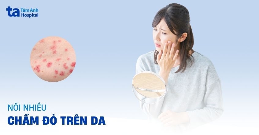 Nổi chấm đỏ trên da: Nguyên nhân, dấu hiệu, chẩn đoán, điều trị