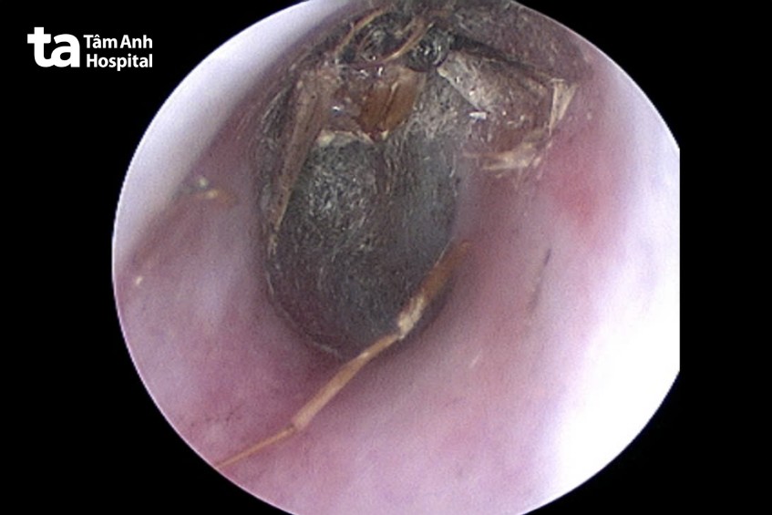 nội soi bướm chui vô tai