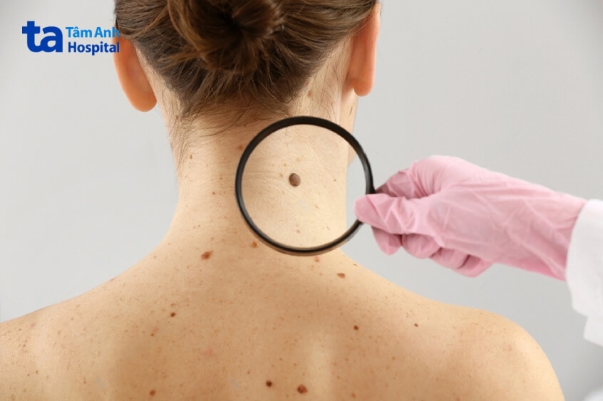 nốt ruồi ung thư hắc tố có thể nhô cao