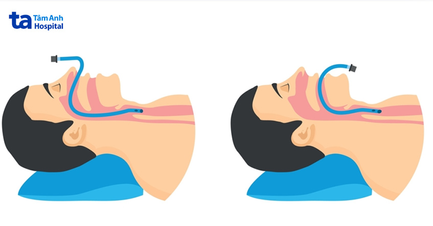 Ống nội khí quản được đưa qua miệng hoặc mũi của người bệnh, đi vào khí quản để hỗ trợ hô hấp