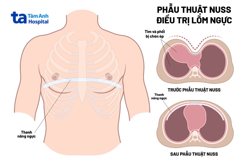 Phẫu thuật Nuss là phương pháp phổ biến trong điều trị lõm ngực