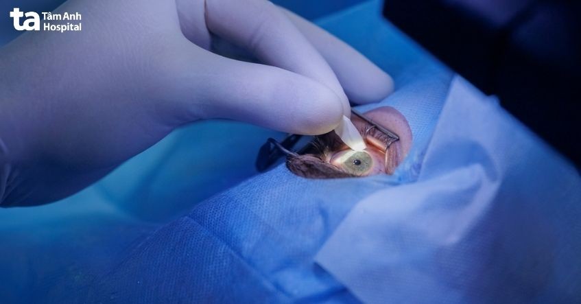 phẫu thuật phaco điều trị đục thủy tinh thể