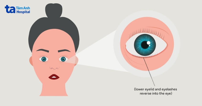 quặm mi dưới gây kích ứng mắt