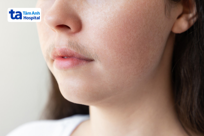 Rậm lông là một triệu chứng của buồng trứng đa nang