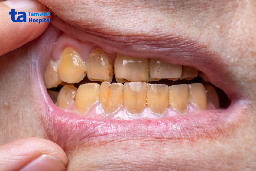 Răng bị xỉn màu có ảnh hưởng gì không?