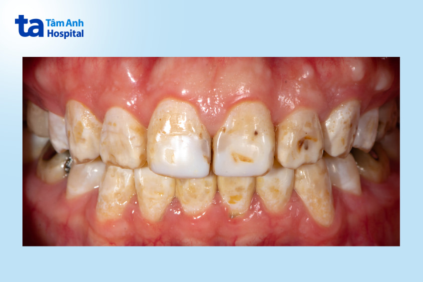 Nguyên nhân gây nhiễm màu răng