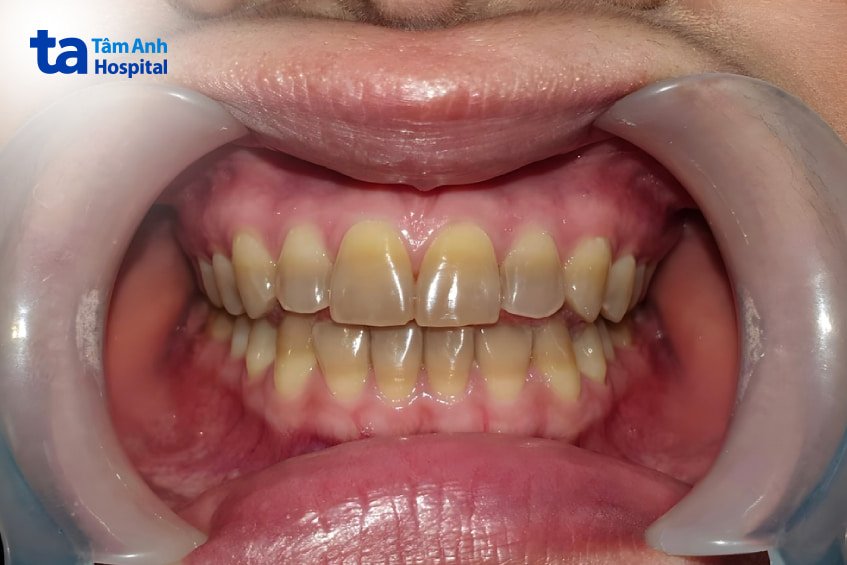 Răng nhiễm màu thuốc kháng sinh