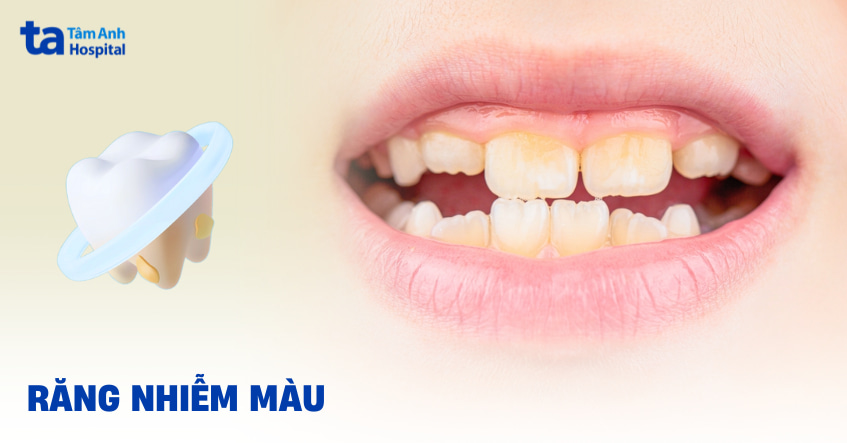 Răng nhiễm màu: Nguyên nhân, triệu chứng và cách khắc phục