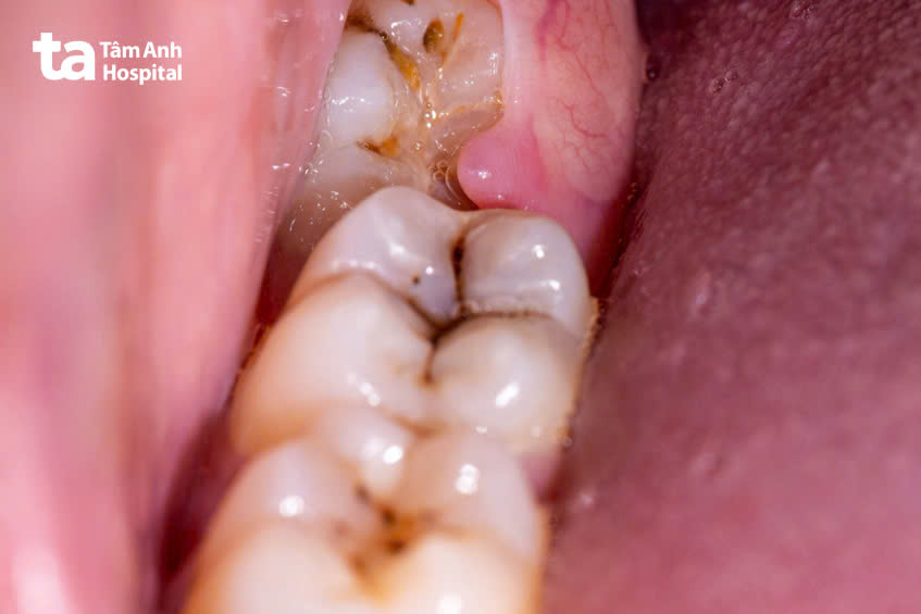 Các vị trí trên răng xuất hiện vệt đen thường gặp