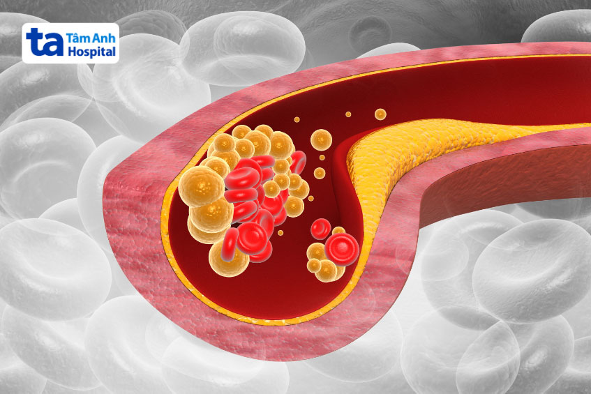 Rối loạn chuyển hóa chất béo xảy ra khi lượng lipid bất thường trong máu