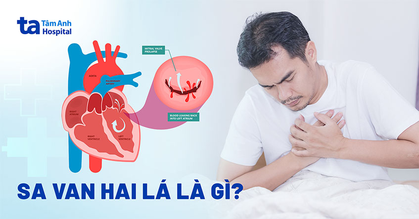 Sa van 2 lá: Nguyên nhân, triệu chứng, chẩn đoán và điều trị