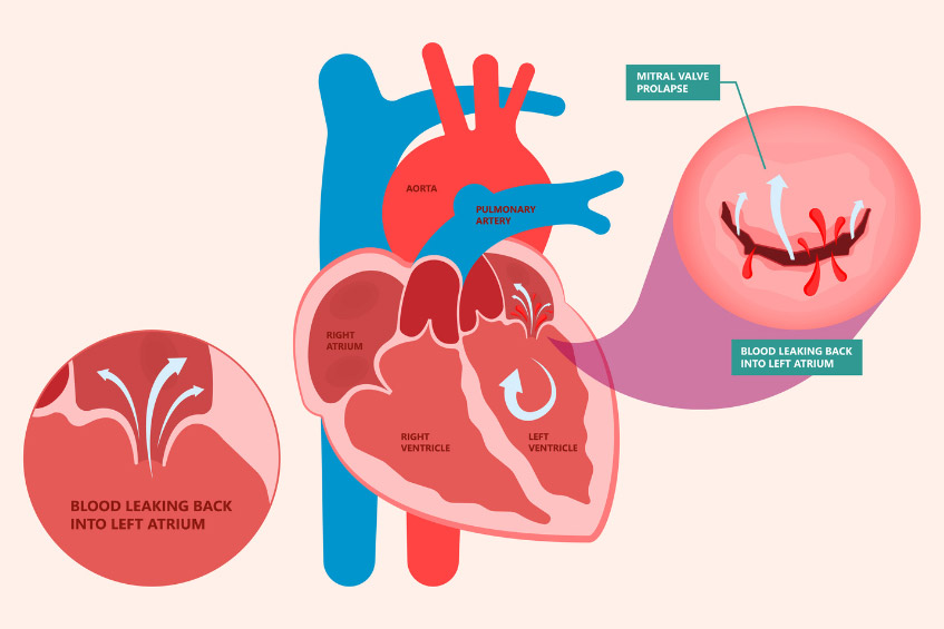 Sa van hai lá khiến máu rò rỉ ngược lại tâm nhĩ trái