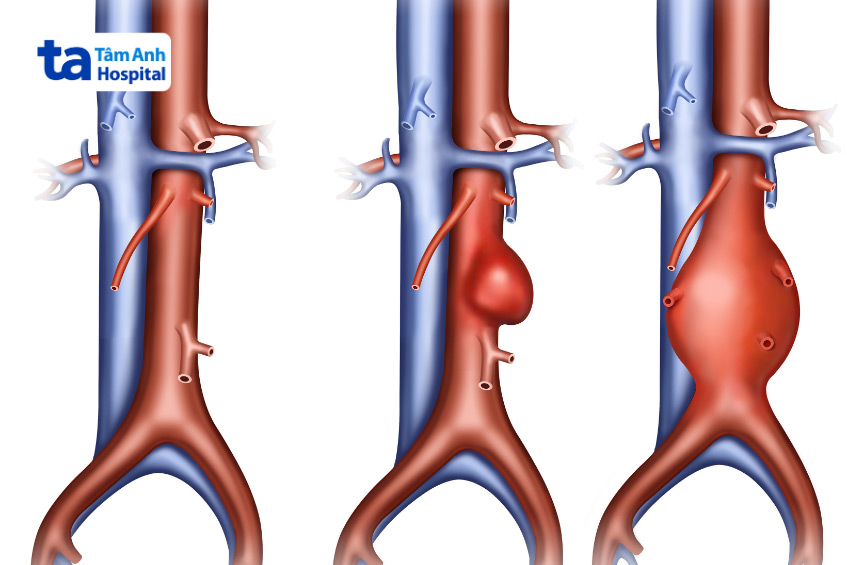 Siêu âm Doppler động mạch chủ giúp phát hiện phình động mạch chủ