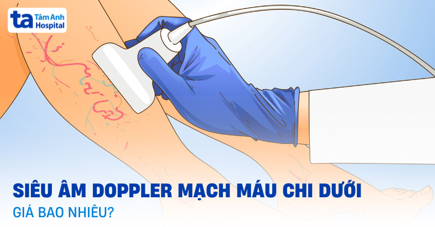 Siêu âm Doppler mạch máu chi dưới giá bao nhiêu? Chỉ định khi nào?