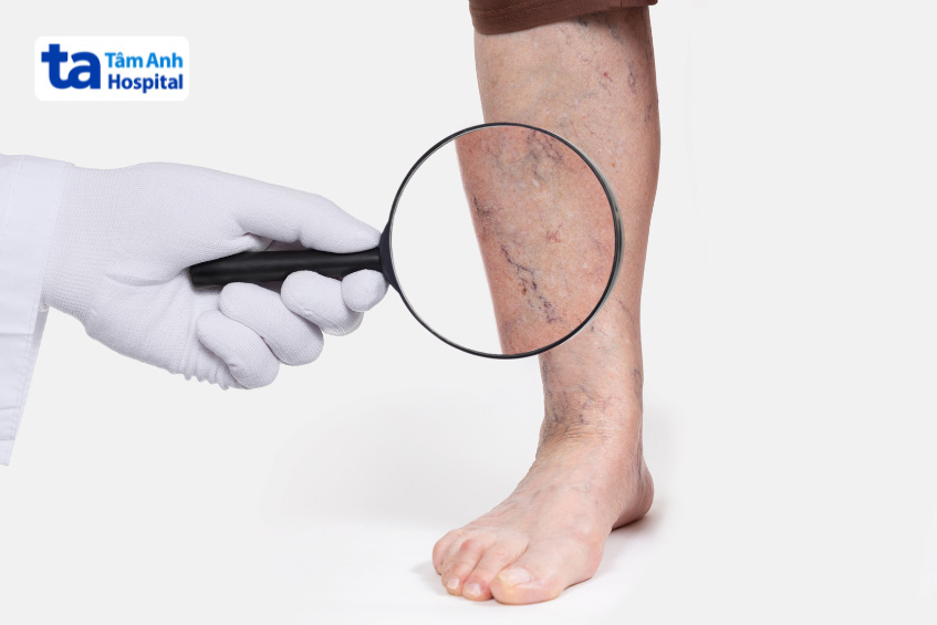 Siêu âm tĩnh mạch chi dưới được chỉ định thực hiện ở bệnh có dấu hiệu suy giãn tĩnh mạch