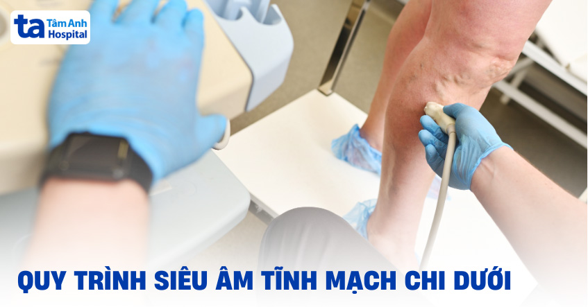 Siêu âm tĩnh mạch chi dưới: Chỉ định, ưu điểm, quy trình, kết quả