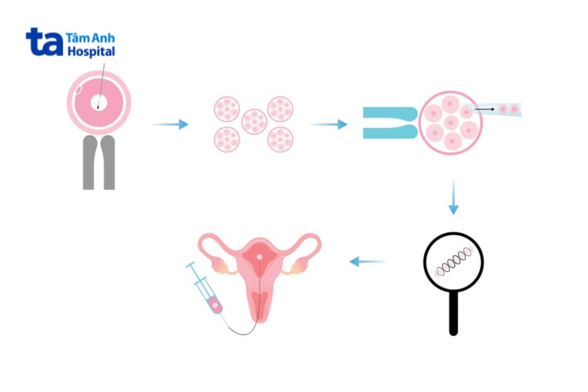 Sinh thiết phôi thai giúp phát hiện sớm các bất thường nhiễm sắc thể gen di truyền