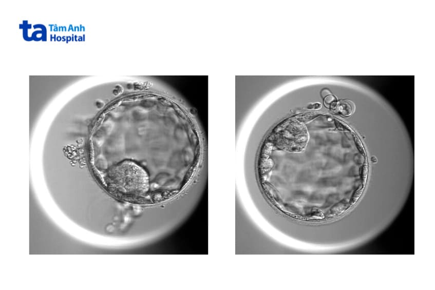 Sinh thiết phôi thường được chỉ định trên phôi nang có đầy đủ tế bào ICM TE